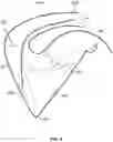 Fig. 09 - Active alignment of commissures in prosthetic heart valve implantation