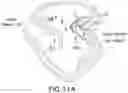 Fig. 18 - DEVICES, SYSTEMS AND METHODS FOR REPAIRING LUMENAL SYSTEMS