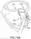 Fig. 22 - DEVICES, SYSTEMS AND METHODS FOR REPAIRING LUMENAL SYSTEMS