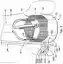 Fig. 06 - AORTIC VALVE REPLACEMENT