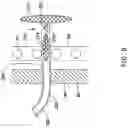 Fig. 10 - AORTIC VALVE REPLACEMENT