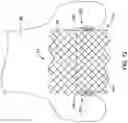 Fig. 13 - AORTIC VALVE REPLACEMENT