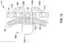 Fig. 17 - AORTIC VALVE REPLACEMENT