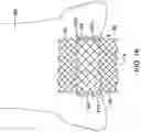 Fig. 20 - AORTIC VALVE REPLACEMENT