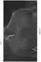 Fig. 27 - APPARATUS AND METHODS FOR TREATING A DEFECTIVE CARDIAC VALVE