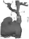 Fig. 48 - APPARATUS AND METHODS FOR TREATING A DEFECTIVE CARDIAC VALVE