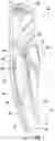 Fig. 02 - Prosthetic implant removal tool and associated method