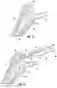 Fig. 08 - Prosthetic implant removal tool and associated method