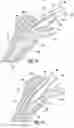 Fig. 09 - Prosthetic implant removal tool and associated method