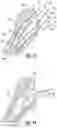 Fig. 11 - Prosthetic implant removal tool and associated method