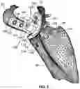 Fig. 03 - GLENOID IMPLANT