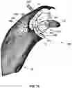 Fig. 11 - GLENOID IMPLANT