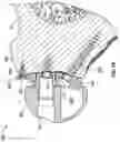Fig. 17 - GLENOID IMPLANT