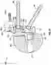 Fig. 24 - GLENOID IMPLANT