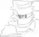 Fig. 01 - Expandable intervertebral fusion implant