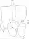 Fig. 04 - Expandable intervertebral fusion implant
