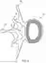 Fig. 05 - Expandable intervertebral fusion implant