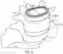 Fig. 06 - Expandable intervertebral fusion implant