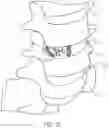 Fig. 14 - Expandable intervertebral fusion implant