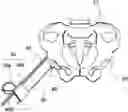 Fig. 01 - Implant guide system for hip replacement surgery