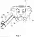 Fig. 02 - Implant guide system for hip replacement surgery