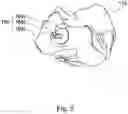 Fig. 07 - Implant guide system for hip replacement surgery