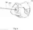 Fig. 08 - Implant guide system for hip replacement surgery