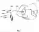 Fig. 09 - Implant guide system for hip replacement surgery