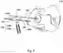 Fig. 10 - Implant guide system for hip replacement surgery