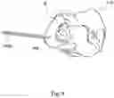 Fig. 11 - Implant guide system for hip replacement surgery