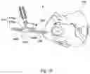 Fig. 12 - Implant guide system for hip replacement surgery