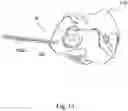 Fig. 14 - Implant guide system for hip replacement surgery