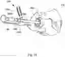 Fig. 16 - Implant guide system for hip replacement surgery