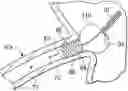 Fig. 01 - Stent delivery under direct visualization