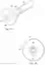 Fig. 04 - Stent delivery under direct visualization