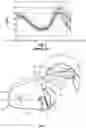 Fig. 03 - PROGRESSIVE FORCE STRAP ASSEMBLY FOR USE WITH AN ORTHOPEDIC DEVICE