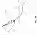 Fig. 10 - Methods, systems, and devices for treating nerve spasticity