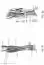 Fig. 17 - Methods, systems, and devices for treating nerve spasticity