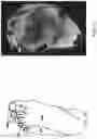 Fig. 20 - Methods, systems, and devices for treating nerve spasticity