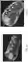 Fig. 21 - Methods, systems, and devices for treating nerve spasticity