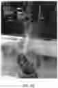 Fig. 07 - EXTERNAL AND INTERNAL INTRAOPERATIVE OPTICAL COHERENCE TOMOGRAPHY IMAGING FOR SUBRETINAL MATERIAL DELIVERY