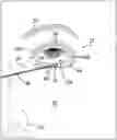 Fig. 01 - METHOD AND DEVICE FOR TREATING AN OCULAR DISORDER