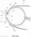 Fig. 17 - METHOD AND DEVICE FOR TREATING EYE DISEASE