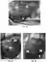 Fig. 19 - GLAUCOMA TREATMENT DEVICES AND METHODS