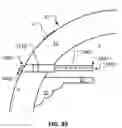 Fig. 21 - GLAUCOMA TREATMENT DEVICES AND METHODS