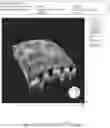 Fig. 49 - SYSTEMS AND METHODS FOR OCULAR LASER SURGERY AND THERAPEUTIC TREATMENTS