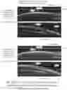 Fig. 60 - SYSTEMS AND METHODS FOR OCULAR LASER SURGERY AND THERAPEUTIC TREATMENTS