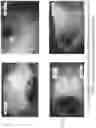 Fig. 66 - SYSTEMS AND METHODS FOR OCULAR LASER SURGERY AND THERAPEUTIC TREATMENTS