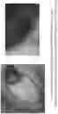 Fig. 76 - SYSTEMS AND METHODS FOR OCULAR LASER SURGERY AND THERAPEUTIC TREATMENTS