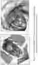 Fig. 77 - SYSTEMS AND METHODS FOR OCULAR LASER SURGERY AND THERAPEUTIC TREATMENTS